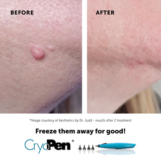 Cryotherapy Treatment (Warts & Skin Tag Removal)