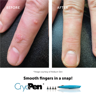 Cryotherapy Treatment (Warts & Skin Tag Removal)
