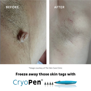 Cryotherapy Treatment (Warts & Skin Tag Removal)